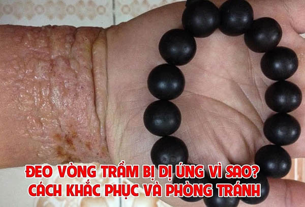 ĐEO VÒNG TRẦM BỊ NGỨA VÀ CÁCH GIẢI QUYẾT